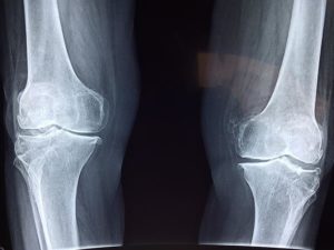 PFPS runner's knee